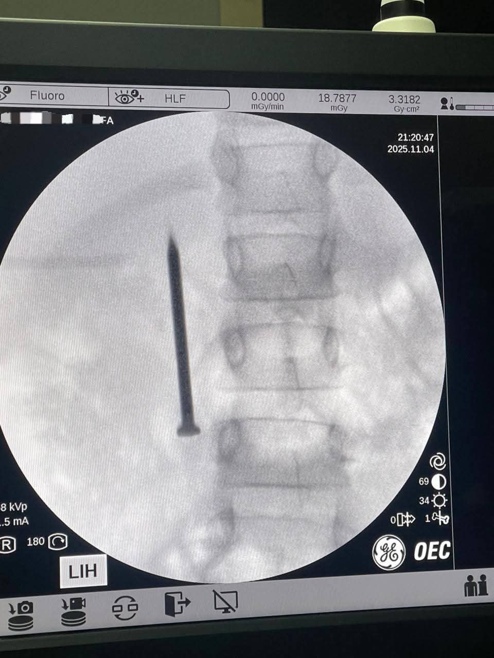 نجاح فريق طبي بمعهد الكبد القومي بجامعة المنوفية في استخراج مسمار حاد من أمعاء طفلة ٧ سنوات في 20 دقيقة