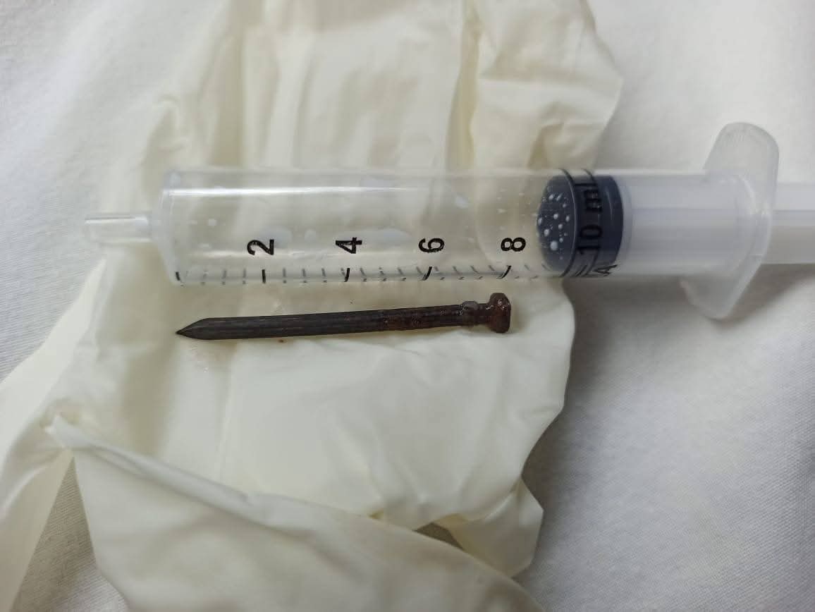 نجاح فريق طبي بمعهد الكبد القومي بجامعة المنوفية في استخراج مسمار حاد من أمعاء طفلة ٧ سنوات في 20 دقيقة (٢)