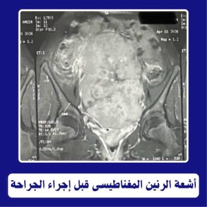 رئيس جامعة طنطا يعلن نجاح فريق طبي في استئصال ورم خبيث يزن ٢ كجم من طفلة بعمر ١٠ سنوات