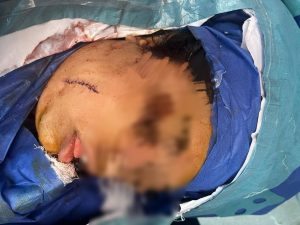 فريق طبي ينقذ مريضة شابة في جراحة دقيقة لاستخراج سكين من قاع الجمجمة داخل طواري قصر العيني